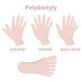 Polydictal hands and feet. Multi-fingering.